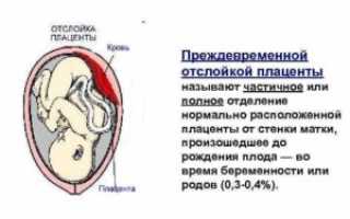 Отслойка плаценты чем опасна