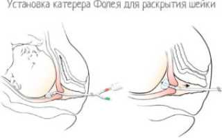 Поставили катетер в шейку матки