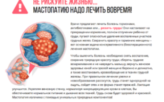 Мастопатия симптомы и признаки при климаксе у женщин