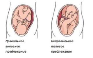 Головное предлежание плода при беременности на 20 недели